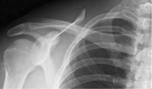 сустав изображён на рентгеновском снимке